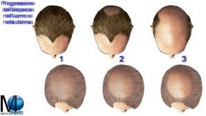 Caduta di capelli nei giovani, tutto quello che c'è da sapere. Minoxidil Efficace Contro Caduta Dei Capelli Alopecia E Calvizie Medicina Online