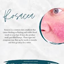 Image result for demodex rosacea