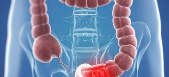 Or to separate groups of numbers referring to different things, as hours from minutes in 5:30; Colon Cancer The Threat Is Real
