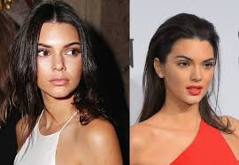 Kendall Jenner Nose Job Plastic Surgery Before And After Photos Kendall Jenner Nose Job Nose Job Plastic Surgery