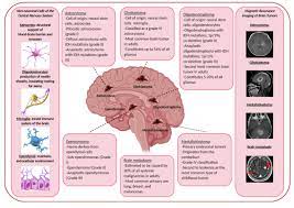 There are several different types of . Malignant Brain Tumors Encyclopedia