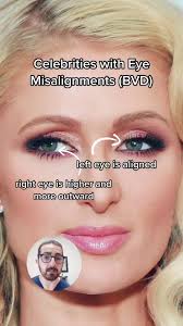What Happened to Paris Hiltons Eye