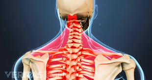 How Soft Tissue Injuries Cause Neck Strain Stenosis Cervical Spinal Stenosis Spinal Stenosis