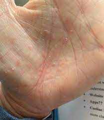 Itchy Palms Little Blisters What Allergy Blog