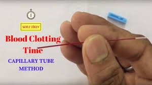Small septal q waves in i, avl, v5 and v6 (duration. Blood Clotting Time Determination By Using Capillary Method à¤¬ à¤²à¤¡ à¤• à¤² à¤Ÿ à¤— à¤Ÿ à¤‡à¤® à¤• à¤¸ à¤ªà¤¤ à¤²à¤— à¤ Youtube