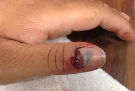 Jul 24, 2017 · splinter hemorrhages can develop after an injury or trauma to a fingernail or toenail. Trick Of Trade Nail Bed Repair With Tissue Adhesive Glue