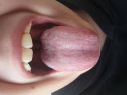 Image result for Puchýře na jazyku