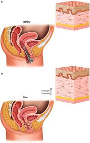 Take a large sheet of aloe and remove the gel from it (as shown in the photo above). Non Surgical Vaginal Tightening Procedures Springerlink
