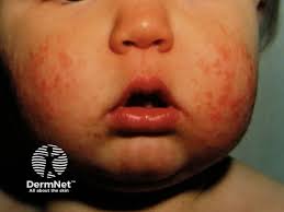 Image result for Papular Acrodermatitis