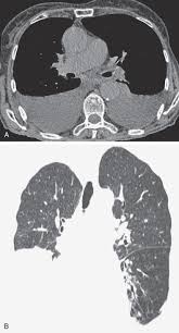 The pleural fluid may loculate between the visceral and parietal pleura (when there is partial fusion of the pleural. Pleural Effusion Radiology Key
