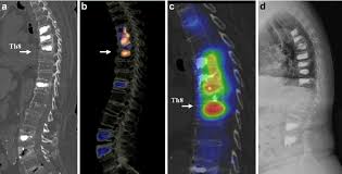Imaging In A 79 Year Old Patient With Osteoporotic Compression Download Scientific Diagram