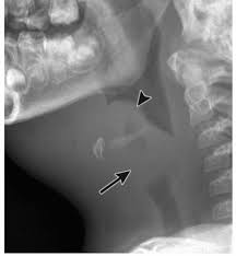 Image result for Epiglottitis