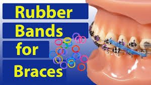 This will make it easier to get the band. Tutorial How To Put Rubber Bands Elastics On Braces Youtube
