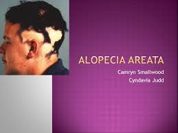 Camryn Smallwood Cyndavia Judd.  Alopecia Areata is a condition that  causes patches of hair loss.  This can be seen in children, men, and  women.  This.