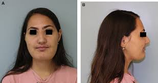 A collection of disease information resources and questions answered by our genetic and rare diseases information specialists for cherubism. Positive Outcomes Of Denosumab Treatment In 2 Patients With Cherubism Journal Of Oral And Maxillofacial Surgery
