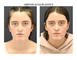 Profile for Been Facial Plastics