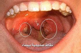 عند القدماء عٌرف التهاب اللوزتين بإسم العٌذرة. Tonsillitis Strep Throat Ø§Ù„ØªÙ‡Ø§Ø¨ Ø§Ù„Ù„ÙˆØ²ØªÙŠÙ†