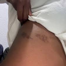 Image result for Varicella zoster on human skin