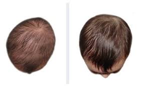 Helmet therapy علاج متلازمة تسطح الرأس