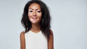 Lorsque des dépôts de cholestérol se forment sur la paroi interne des artères qui alimentent le cœur, leur diamètre elle est généralement plus intense lorsque l'effort physique qui la provoque est associé à la prise d'un repas, une exposition au froid ou au vent, ou un. Cause Symptomes Qu Est Ce Que L Angine De Poitrine Femme Actuelle Le Mag