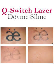 Q Switch Lazer Dovme Silme Dovme Yag Renkler