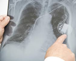 A pacemaker is a small device that helps maintain a healthy heart beat using electrical impulses. Heart Pacemaker Surgery Purpose Procedure And Risks