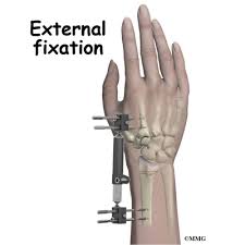Leave that task to the professionals place the splint so that it rests on the joint above and the joint below the injury. Conditions And Treatments