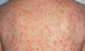 Check spelling or type a new query. Pityriasis Rosea Medaljongsjuka Internetmedicin