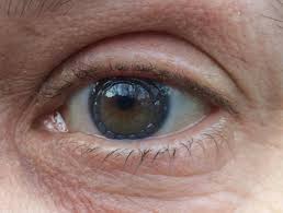 Pin On Corneal Transplant