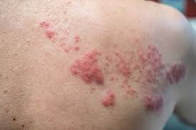 Image result for shingles