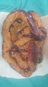 Its use was first described by oswaldo borraez while he was a resident in bogotá, colombia. Ali Cihat Yildirim Ø¹Ù„Ù‰ ØªÙˆÙŠØªØ± Open Abdomen Procedure With Bogota Bag And Temporary Jejunostomy