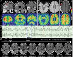 Besides aducanumab, this trial evaluates the performance of proposed research diagnostic criteria. Symptomatic Amyloid Related Imaging Abnormalities In An Apoe E4 E4 Patient Treated With Aducanumab Vandevrede 2020 Alzheimer S Amp Dementia Diagnosis Assessment Amp Disease Monitoring Wiley Online Library