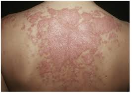 Which of these ten types of magic will you acquire? Cutaneous Lupus Erythematosus An Overview Mdedge Dermatology