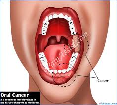 Mouth cancer, also known as oral cancer, is where a tumour develops on the surface of the lip, mouth if mouth cancer is suspected, you will be referred to hospital for further tests or to speak to a while it kills cancerous cells, radiotherapy can also affect healthy tissue, and it has a number of. Oral Cancer Causes Symptoms Treatment Stages Survival Rate Prevention