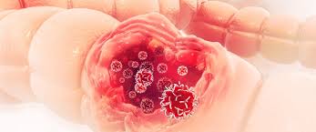 Colonoscopy — indications and contraindications. Ø³Ø±Ø·Ø§Ù† Ø§Ù„Ù‚ÙˆÙ„ÙˆÙ† Ø£Ø¹Ø±Ø§Ø¶ ÙˆØ¹Ù„Ø§Ø¬ Ø³Ø±Ø·Ø§Ù† Ø§Ù„Ù‚ÙˆÙ„ÙˆÙ† ÙˆÙŠØ¨ Ø·Ø¨