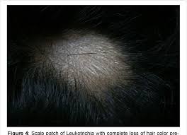 Vitiligo may also be hereditary; Figure 4 From Behavior Of Hair Follicles In Vitiligo Clinical Presentation And Discussion Semantic Scholar