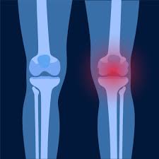 Image result for Knee XRay