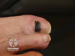 Image result for Acral lentiginous melanoma nail