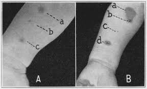 Schick test — the schick test, invented between 1910 and 1911, is a test used to determine whether or not a person is susceptible to diphtheria. Https Jamanetwork Com Journals Peds Articlepdf 1178462 Archpedi 57 3 008 Pdf