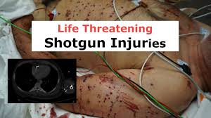 Shotguns launch shot in a string. Life Threatening Shotgun Injuries Youtube