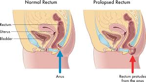Image result for Rectal prolapse