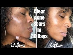 Pin On Getting Rid Of Acne And Scars