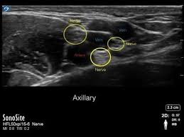 Image result for Axillary Nerve Block