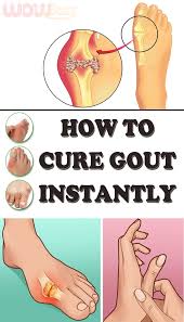 Natural Ways To Treat Gout How To Cure Gout Gout Remedies Gout