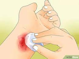 How To Treat Carpet Burns (With Pictures) - Wikihow