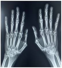 Image result for XRay Changes in Rheumatic Conditions