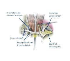 Fragen zu / schmerzen nach leistenbruch op? Leistenbruch Main Chirurgie