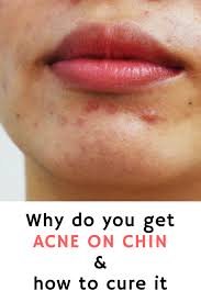 Acne On Chin Causes Cure Pimplesonchin Chin Acne Cheek Acne Chin Acne Causes