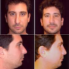 Rhinoplasty