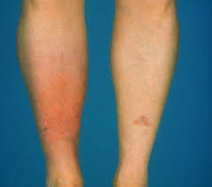 Cellulitis usually affects the skin on the lower legs, but it can occur in the face, arms and other areas. Prophylactic Antibiotics May Be Best Bet For Preventing Cellulitis Recurrence Dermatology Advisor